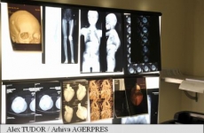 radiografii osteoporoza