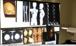 radiografii osteoporoza
