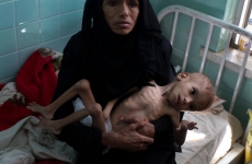 Malnutritie yemen