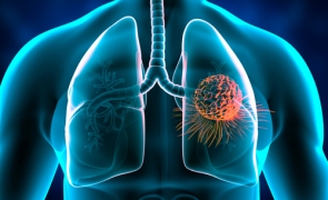 cancer pulmonar
