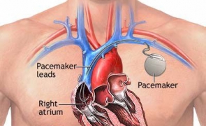 stimulator cardiac