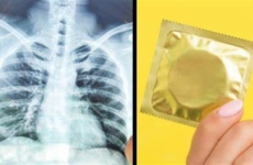 prezervativ plamani
