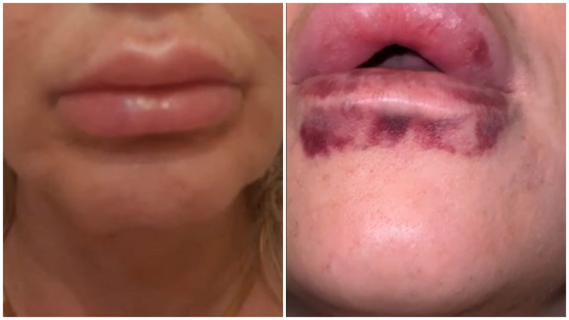 FOTO Pericolul din spatele botoxului 'de Facebook': 'Opera&#539;ii' cu final la Urgen&#539;e, f&#259;cute de o fals&#259; doctori&#539;&#259;